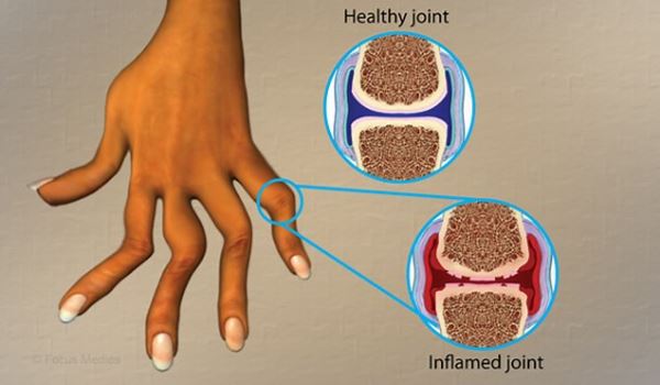 Rheumatoid Arthritis 